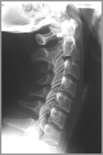 Fractures and Dislocations of the Cervical Spine